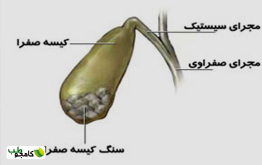 کیسه صفرا