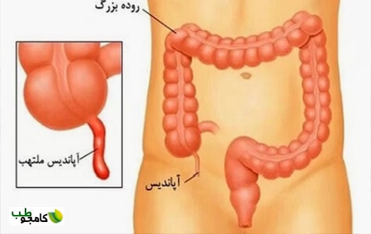 آپاندیس