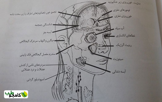 میگرن