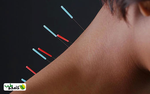 طب سوزنی در استرس